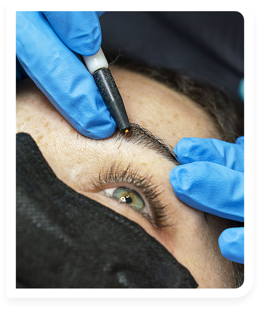 Tratamiento de electrólisis en el área de las cejas